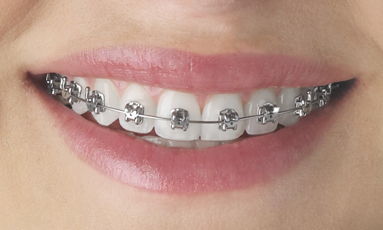 Smile wearing traditional metal braces