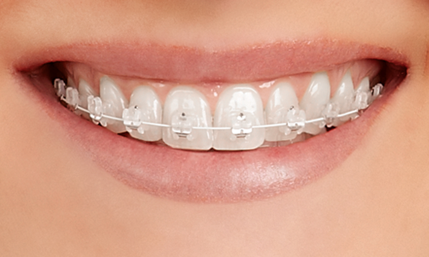 Smile wearing tooth-colored ceramic braces